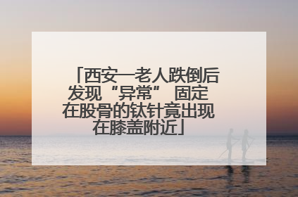 西安一老人跌倒后发现“异常” 固定在股骨的钛针竟出现在膝盖附近